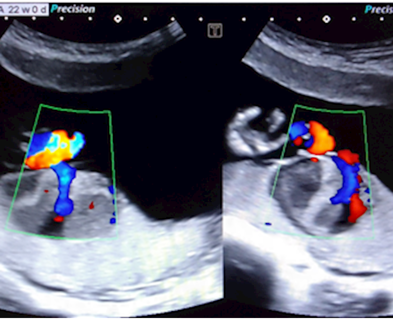 Prenatal diagnosis of placental chorioangioma on ultrasound